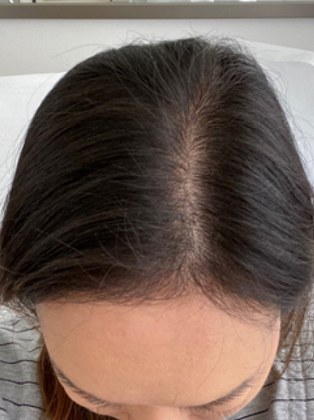 Scalp parting after using Trichovex