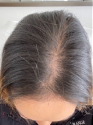 Scalp parting before using Trichovex